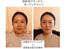 【小顔コルギ＋スイス美肌機器バイオプトロン】毛穴＆美肌◎