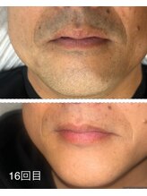 ラヴィエール(Laviere)/【メンズ脱毛】お髭16回目