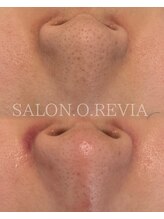 サロン オ レヴィア(SALON.O.REVIA)/ごっそり水素毛穴洗浄