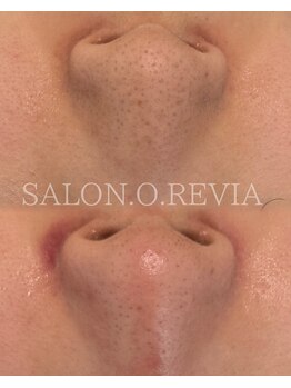 サロン オ レヴィア(SALON.O.REVIA)/ごっそり水素毛穴洗浄