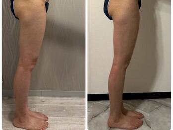 フュース(Futh)/1回の効果/膝上の脂肪/即効性