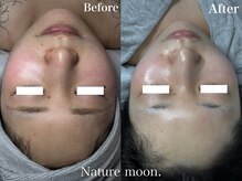 ナチュールムーン(Nature moon.)/ハーブピーリング