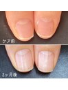 自爪育成