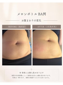 インディバ アンド ルヴィ 沖縄店(INDIBA&REVI)の写真/次世代ボディメイク！気になる脂肪に集中アプローチで、すっきり理想のボディラインへ
ダウンタイムなし！