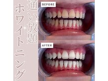 エクシアホワイトニング 草津店/ホワイトニングビフォーアフター