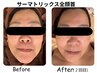 【リフトアップ人気NO.1】速攻小顔シワたるみケア！サーマトリックス全顔首