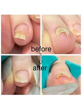 カラーホリック ネイルスパ(Colorholic Nailspa)/巻き爪補正