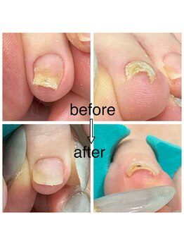 カラーホリック ネイルスパ(Colorholic Nailspa)/巻き爪補正