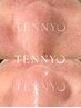《毛穴悩み》温泉水90%パック+水素水毛穴洗浄+セラム付¥14500→¥11980