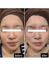 シス(SiS.)/ハーブピーリング一回目