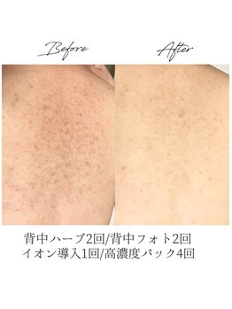 ビズビズ 梅田店(bisebise)/〈症例〉背中改善