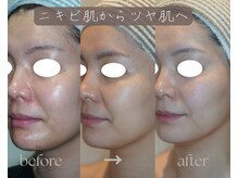 岩川治療院/ニキビ肌からツヤ肌へ