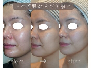 岩川治療院/ニキビ肌からツヤ肌へ