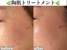 ホワイトアクア 錦糸町店(WHITE AQUA)/ハーブピーリング/東京/錦糸町