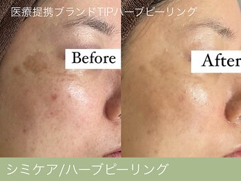 オーエン 小倉店(o-eN)/シミケア/ハーブピーリング