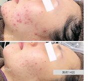 ニキビ研究所 千葉店/40代大人ニキビも◎