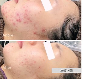 ニキビ研究所 千葉店/40代大人ニキビも◎