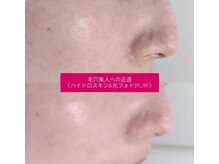 ユニクリア(Uni clear)の雰囲気（毛穴・くすみ・シミケア・透明感・ノーファンデ肌★ユニクリア）