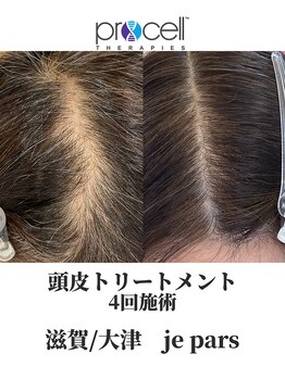ジュパール(je pars)/プロセル頭皮トリートメント