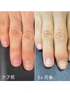 自爪育成