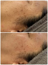 サロンドール(SalonDoll)/陶肌トリートメント