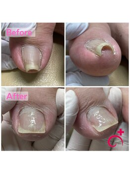 ドクター巻き爪 本厚木院(Dr.巻き爪)/40代男性!すぐに分かる変化!