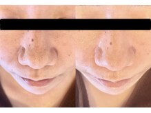 クレール(Claire)/毛穴を綺麗に！黒ずみ/皮脂/開き