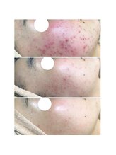 エヌエー(na)/肌質改善・赤ら肌