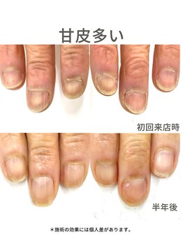 50代/甘皮多い/アフター