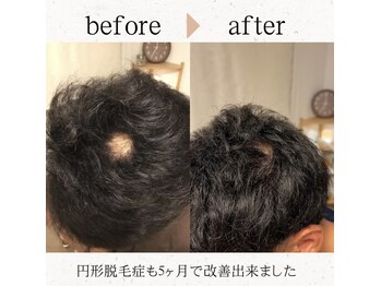 ハリング(HARIING)/before→after