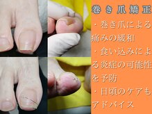 長野市内検索トップに表示される『巻き爪』。相談数もトップです