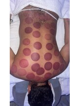 中国整体 らくらく堂/人気★独自の温熱療法吸い玉