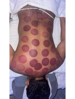 中国整体 らくらく堂/人気★独自の温熱療法吸い玉