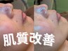 【肌質改善】プラズマ×ハーブピーリング★幹細胞カクテル導入 ¥15,450