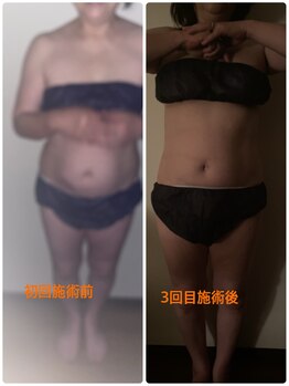 リンパセラピーファシル(Facile)/たった3回