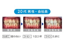 ホワイトニングカフェ イオン新潟青山店(WhiteningCafe)/★ビフォーアフター★