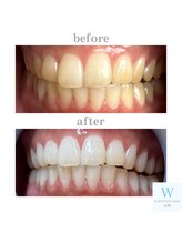 ホワイトニングショップ 長野店/【初回無料になるチャンス！？】