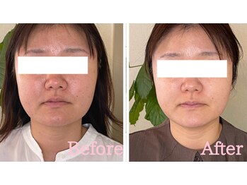 小顔矯正サロン ブルーム/施術3回ビフォーアフター