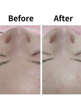 ユニクリア(Uni clear)/毛穴洗浄ピーリング