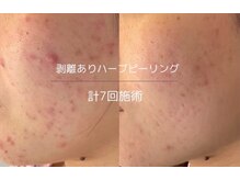 ライフサロン 天神(Life Salon)/メンズハーブピーリング