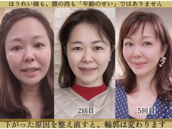 サロンチオリ 烏丸(Salon Chiori)の写真/ほうれい線は結果ではなく、日々下方向へ引かれる状態が、肌の上で重なり深く定着していく進行型の変化です
