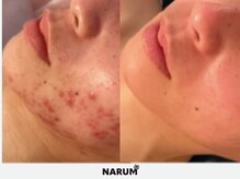 ナルムフェイシャル 代々木(NARUM facial)/水光ピーリング