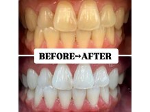 ホワイトニングサロン 豊中/Before&After美白ホワイトニング