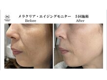 シャムロック/光お顔ケア！ビフォーアフター