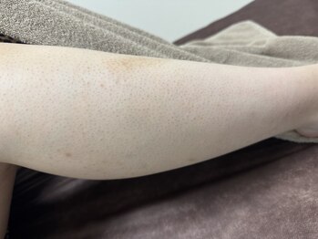 ハク(HAKU)/脱毛経過