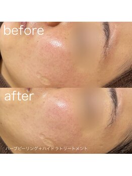 ルルラ リコ(lulula rico)/症例写真/ハーブピーリング