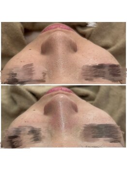 リグレム バイ フェローズ(Riglem by fellows)/毛穴洗浄ハイドロトリートメント