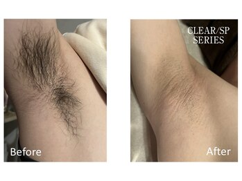 アットイカウ 下北沢(at ikaw)/ワキ脱毛 Before/After