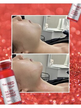 エステルーム クリスタル/渡韓せずに叶う！輪郭形成