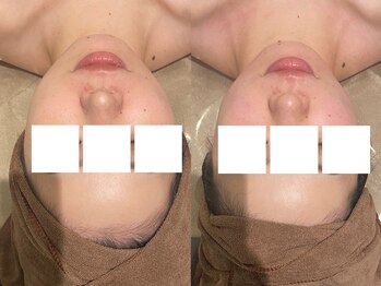 フォルチェ はません店(Folche)/小顔/むくみ/フェイスライン